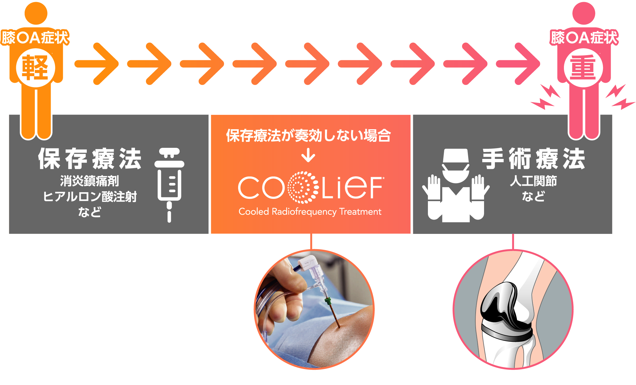 Coolief 治療の選択