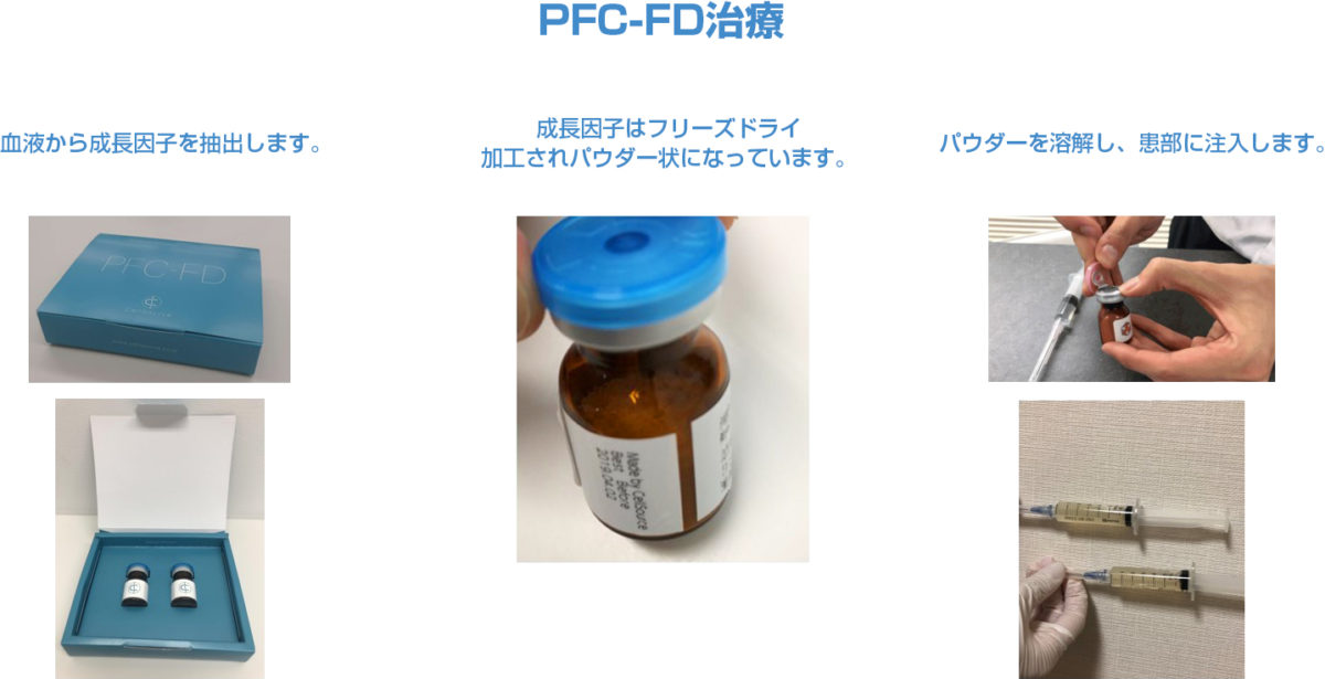 PFC治療